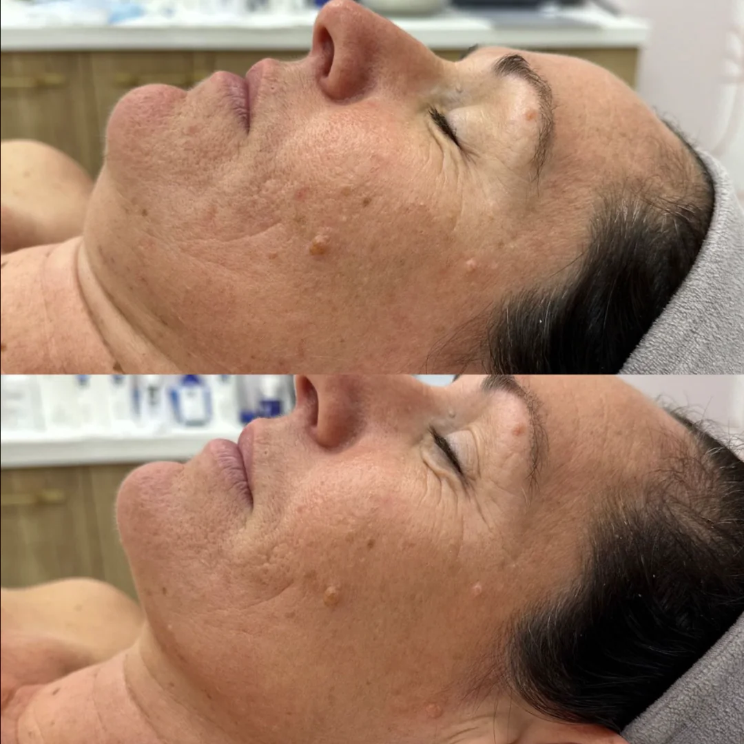 Before and after results of Dermapen treatment for acne scars performed by Alicia Lowther Aesthetics in Gladstone, QLD.