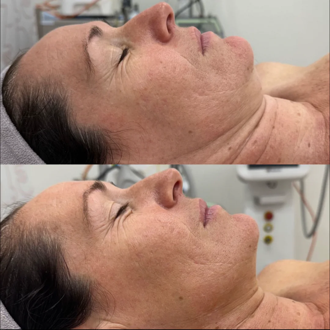 Before and after results of Dermapen treatment for acne scars performed by Alicia Lowther Aesthetics in Gladstone, QLD.