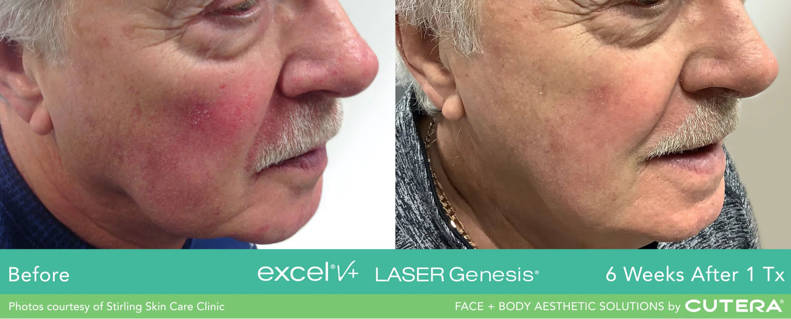 Before and after results of a Laser Genesis treatment, courtesy of Cutera.