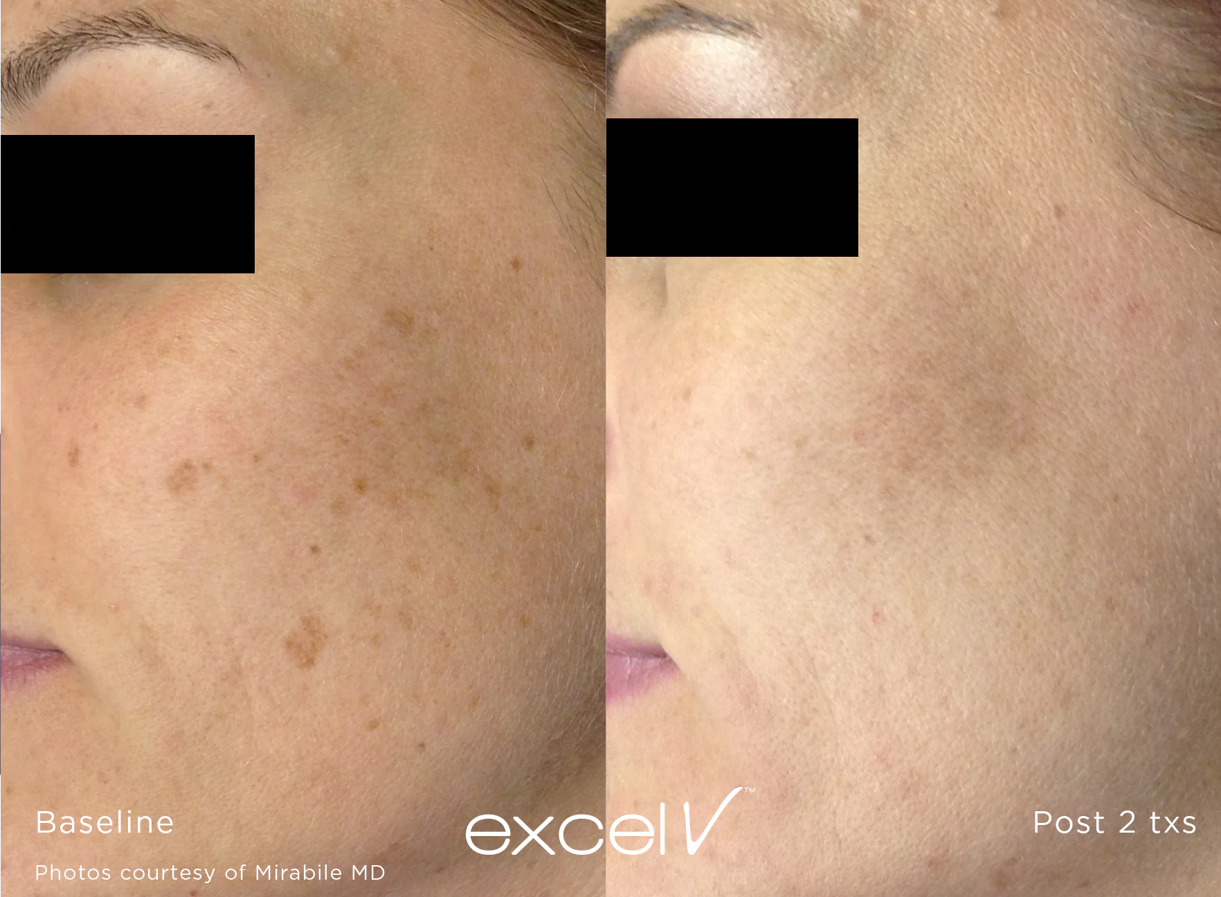 Before and after results of a Laser Genesis treatment, courtesy of Cutera.